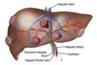 obat tumor hati herbal